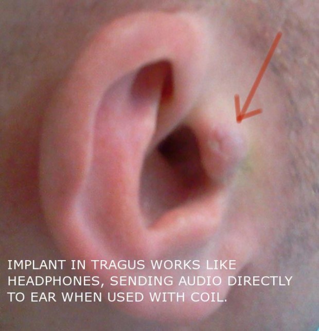 Rich Lee's in-ear implant
